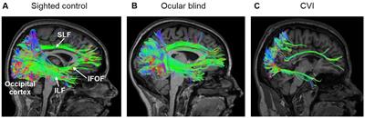 Frontiers | Cerebral Versus Ocular Visual Impairment: The Impact On ...